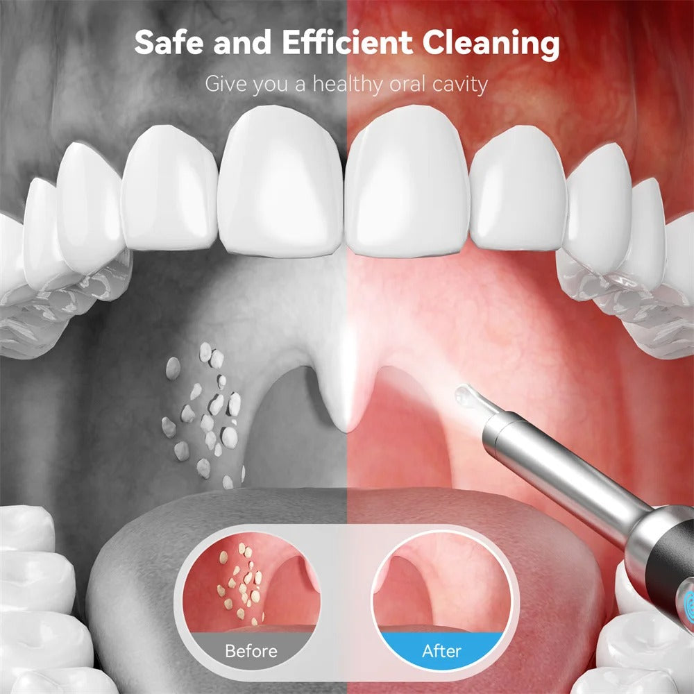 Visual Tonsil Stone Remover